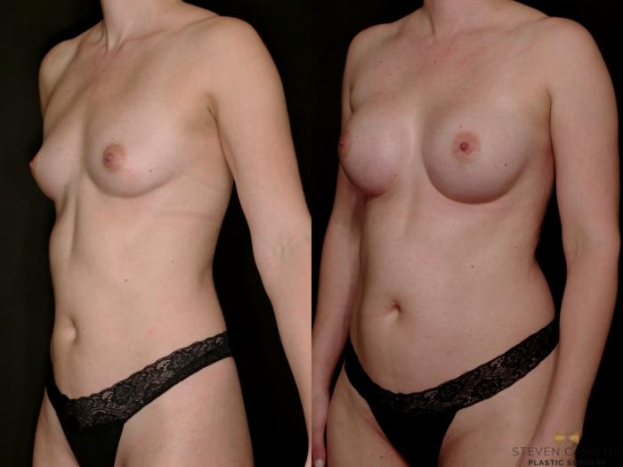 Before & After Breast Augmentation Case 765 Left Oblique View in Fort Worth & Arlington, Texas