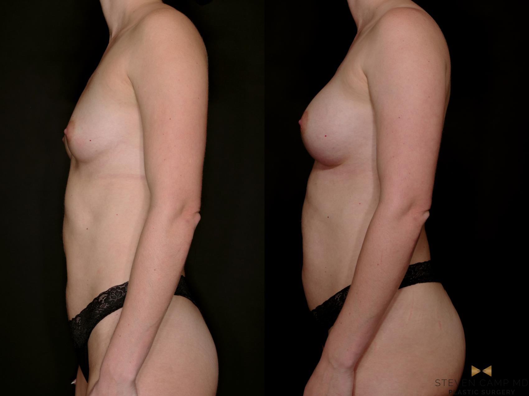 Before & After Breast Augmentation Case 765 Left Side View in Fort Worth & Arlington, Texas