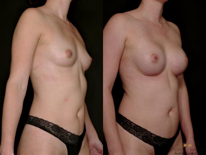 Before & After Breast Augmentation Case 765 Right Oblique View in Fort Worth & Arlington, Texas