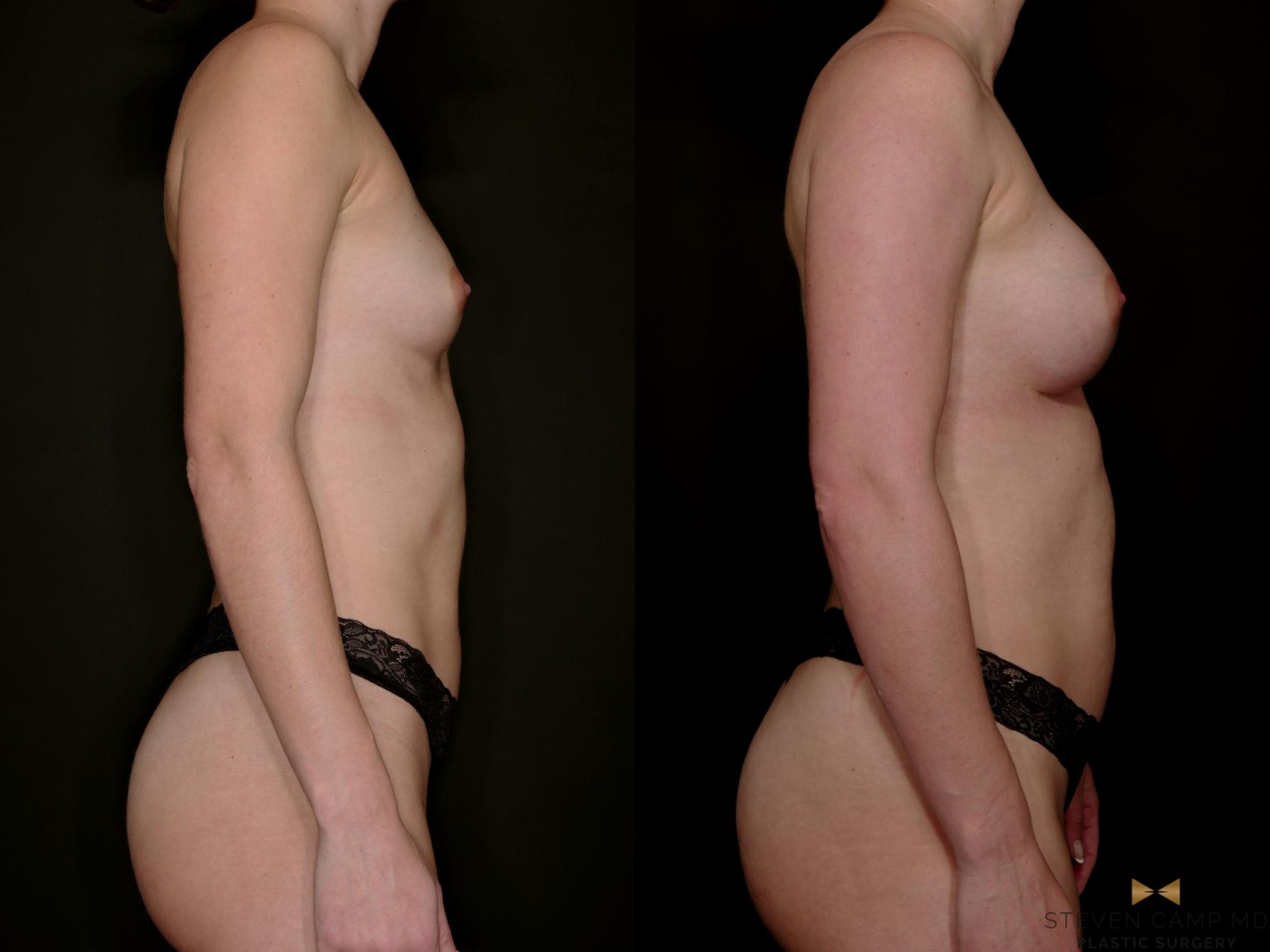 Before & After Breast Augmentation Case 765 Right Side View in Fort Worth & Arlington, Texas