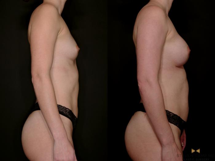 Before & After Breast Augmentation Case 765 Right Side View in Fort Worth & Arlington, Texas