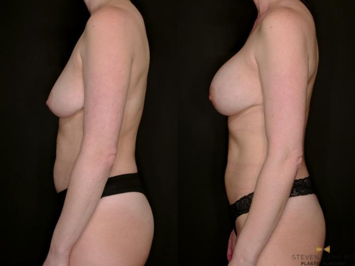Before & After Breast Augmentation Case 766 Left Side View in Fort Worth & Arlington, Texas