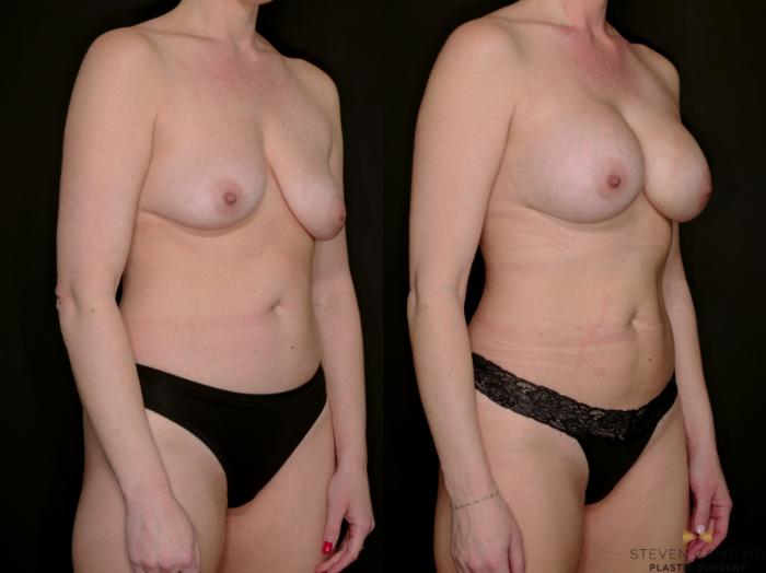 Before & After Breast Augmentation Case 766 Right Oblique View in Fort Worth & Arlington, Texas
