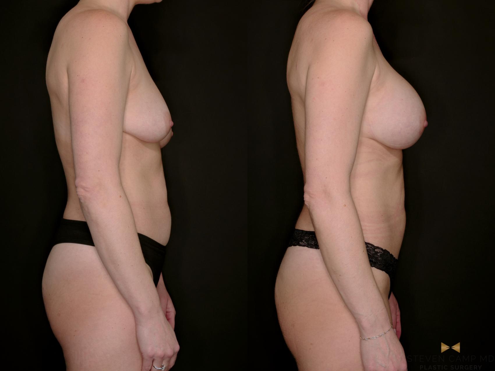 Before & After Breast Augmentation Case 766 Right Side View in Fort Worth & Arlington, Texas
