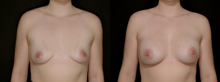 Before & After Breast Augmentation Case 778 Front View in Fort Worth & Arlington, Texas