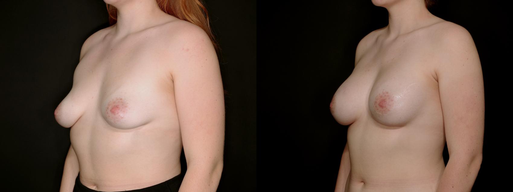 Before & After Case 90025 by Steven Camp MD Plastic Surgery & Aesthetics, in Fort Worth