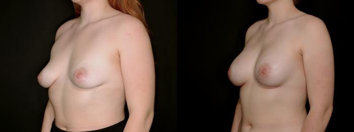 Before & After Breast Augmentation Case 778 Left Oblique View in Fort Worth & Arlington, Texas