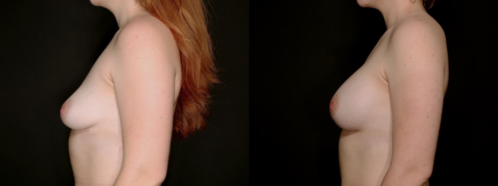 Before & After Breast Augmentation Case 778 Left Side View in Fort Worth & Arlington, Texas