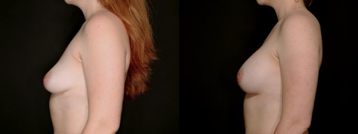 Before & After Breast Augmentation Case 778 Left Side View in Fort Worth & Arlington, Texas