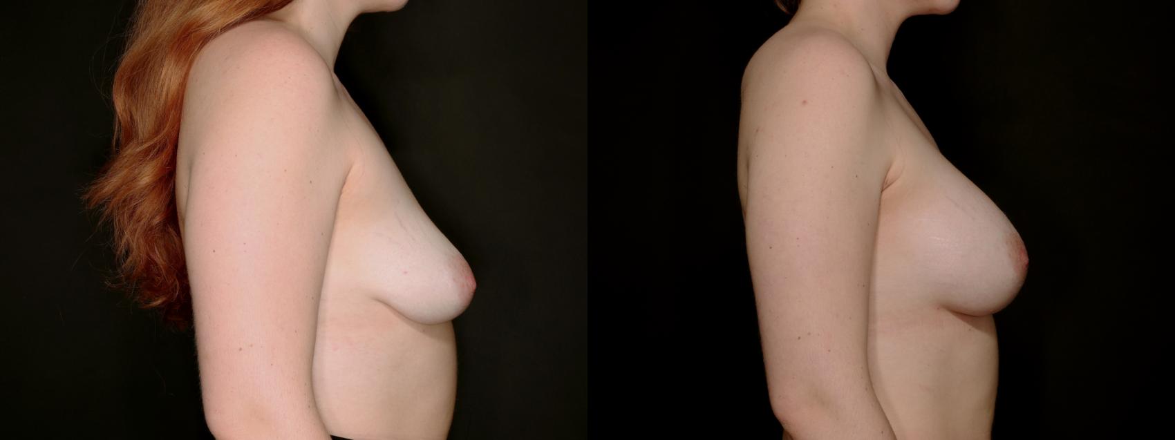 Before & After Breast Augmentation Case 778 Right Side View in Fort Worth & Arlington, Texas