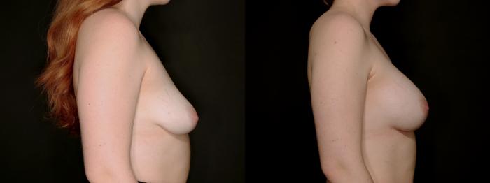 Before & After Breast Augmentation Case 778 Right Side View in Fort Worth & Arlington, Texas
