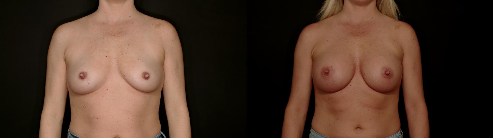 Before & After Breast Augmentation Case 782 Front View in Fort Worth & Arlington, Texas