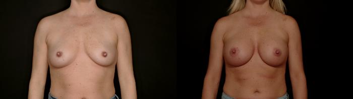 Before & After Breast Augmentation Case 782 Front View in Fort Worth & Arlington, Texas