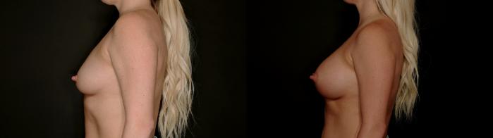 Before & After Breast Augmentation Case 782 Left Side View in Fort Worth & Arlington, Texas