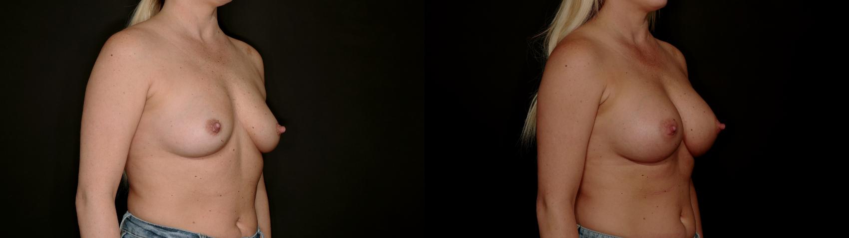 Before & After Breast Augmentation Case 782 Right Oblique View in Fort Worth & Arlington, Texas
