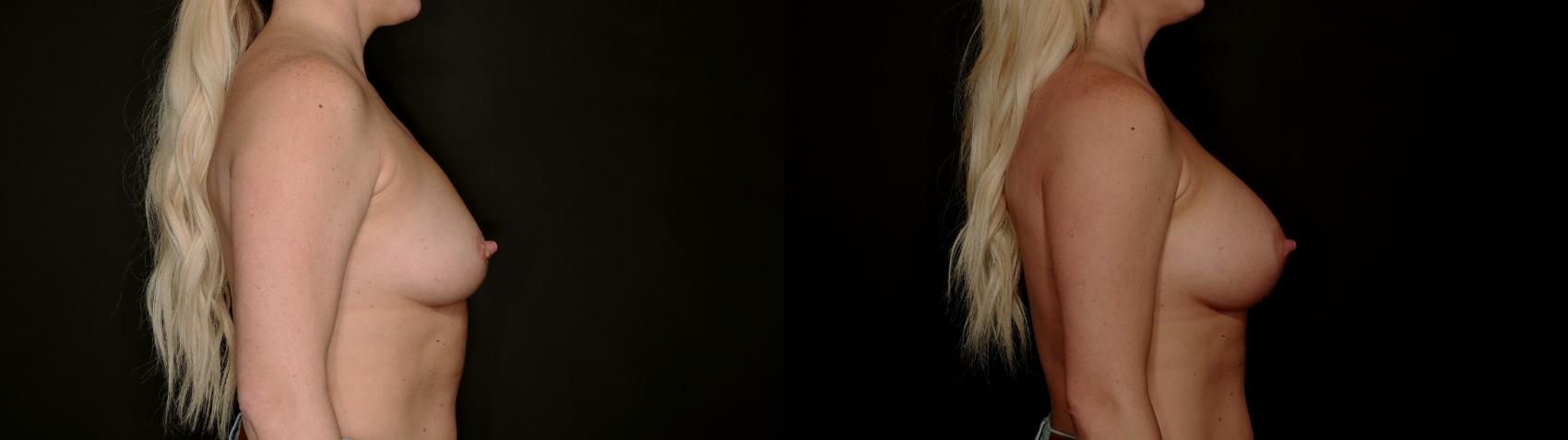 Before & After Breast Augmentation Case 782 Right Side View in Fort Worth & Arlington, Texas