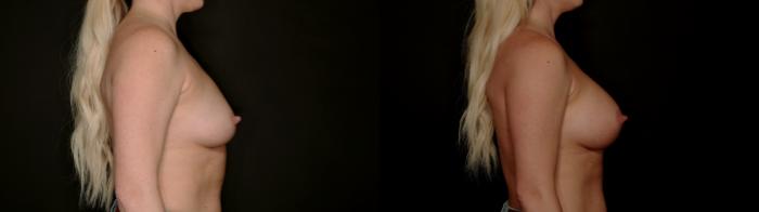 Before & After Breast Augmentation Case 782 Right Side View in Fort Worth & Arlington, Texas