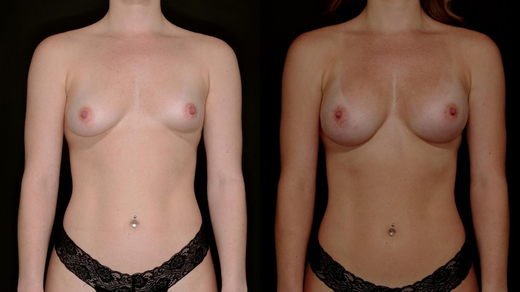 Before & After Breast Augmentation Case 784 Front View in Fort Worth & Arlington, Texas