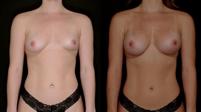 Before & After Breast Augmentation Case 784 Front View in Fort Worth & Arlington, Texas