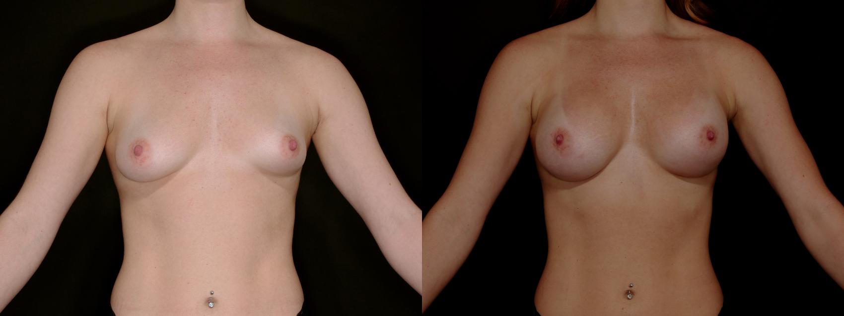 Before & After Breast Augmentation Case 784 Frontal Arms Up  View in Fort Worth & Arlington, Texas