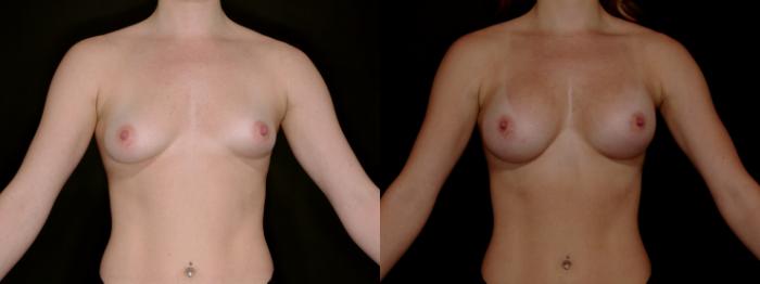 Before & After Breast Augmentation Case 784 Frontal Arms Up  View in Fort Worth & Arlington, Texas