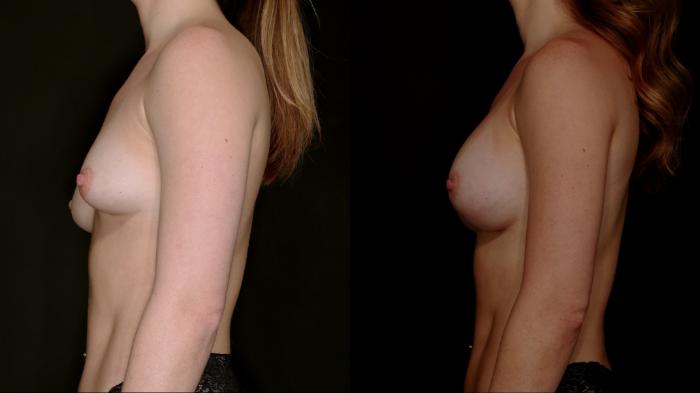 Before & After Breast Augmentation Case 784 Left Side View in Fort Worth & Arlington, Texas