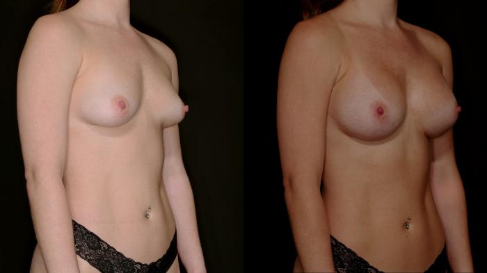 Before & After Breast Augmentation Case 784 Right Oblique View in Fort Worth & Arlington, Texas