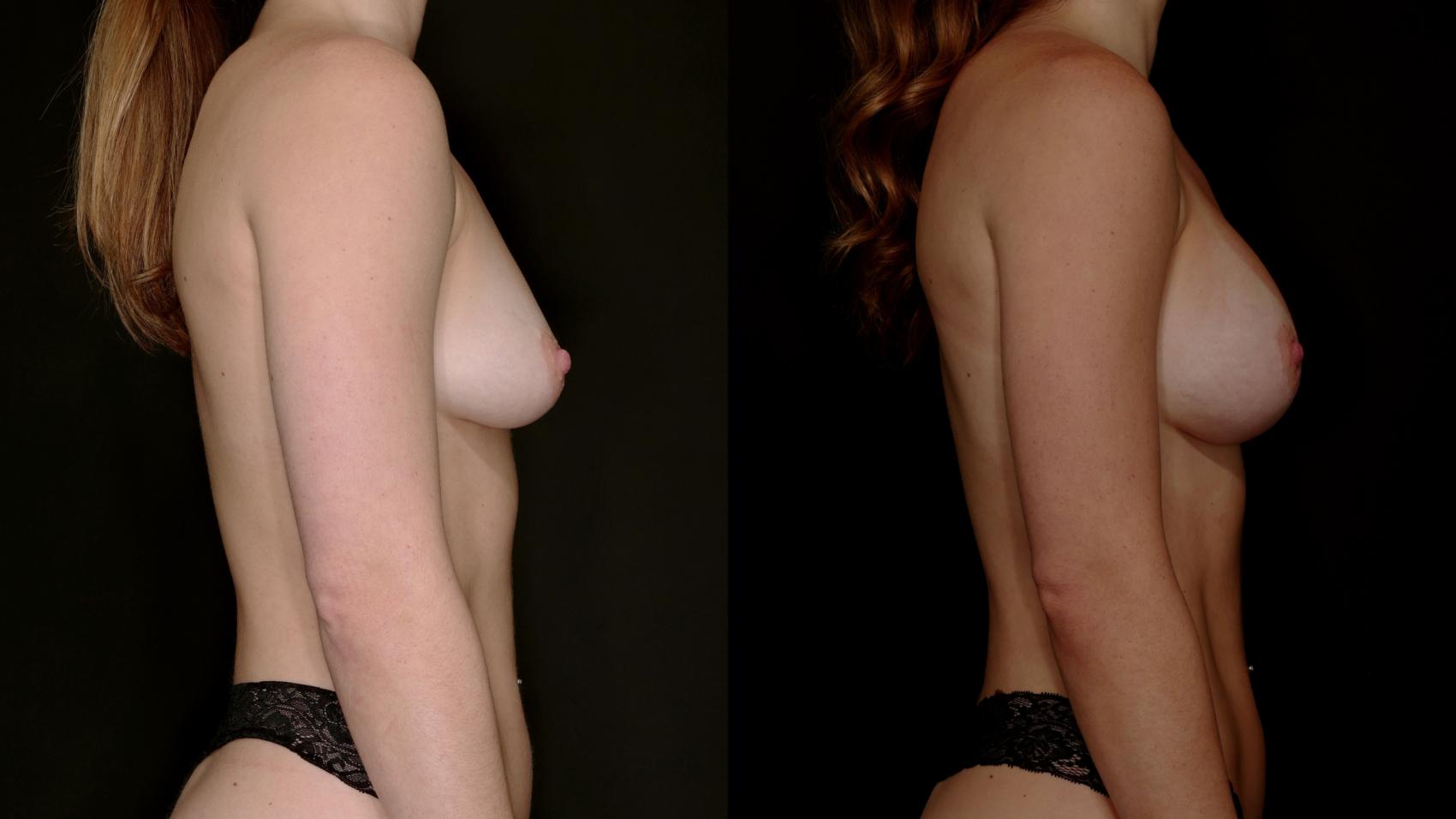 Before & After Breast Augmentation Case 784 Right Side View in Fort Worth & Arlington, Texas