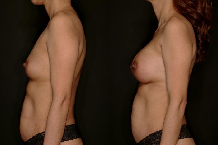 Before & After Breast Augmentation Case 786 Left Side View in Fort Worth & Arlington, Texas