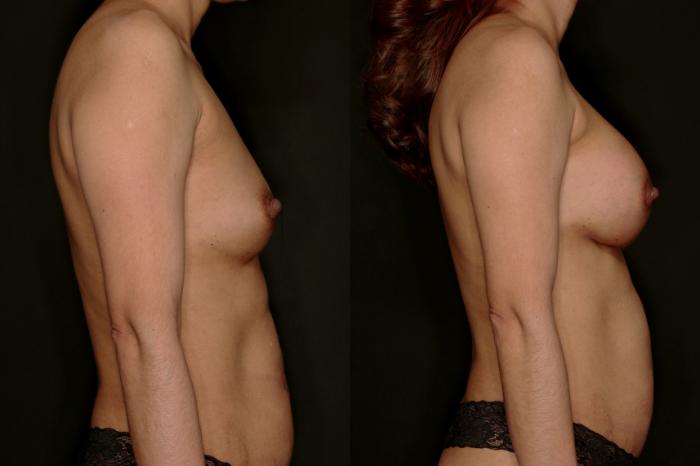 Before & After Breast Augmentation Case 786 Right Side View in Fort Worth & Arlington, Texas