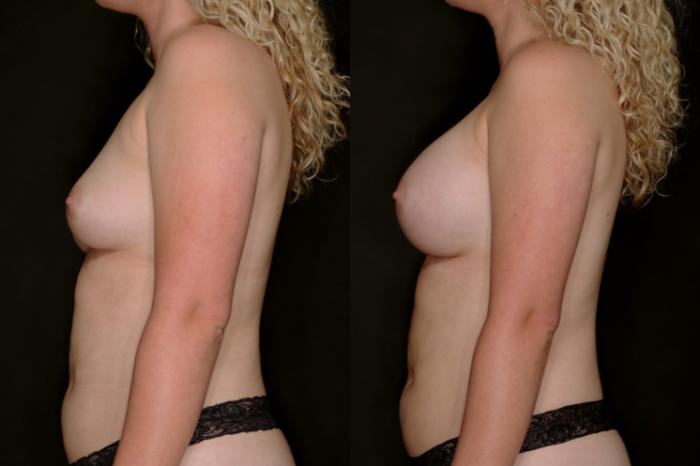 Before & After Breast Augmentation Case 789 Left Side View in Fort Worth & Arlington, Texas