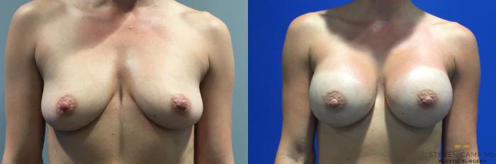 Before & After Breast Augmentation Case 90 View #1 View in Fort Worth, Texas