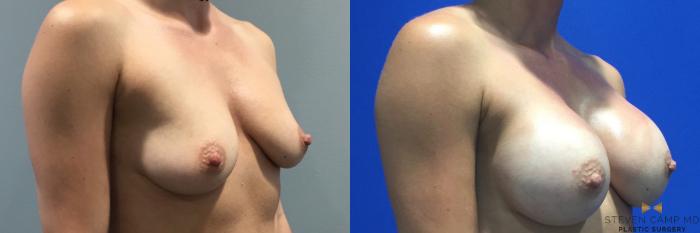 Before & After Breast Augmentation Case 90 View #2 View in Fort Worth & Arlington, Texas