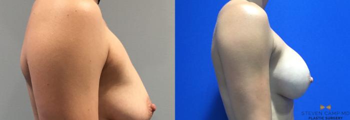 Before & After Breast Augmentation Case 90 View #3 View in Fort Worth & Arlington, Texas