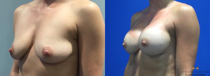 Before & After Breast Augmentation Case 90 View #4 View in Fort Worth, Texas