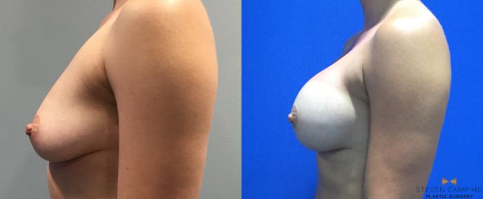 Before & After Breast Augmentation Case 90 View #5 View in Fort Worth & Arlington, Texas