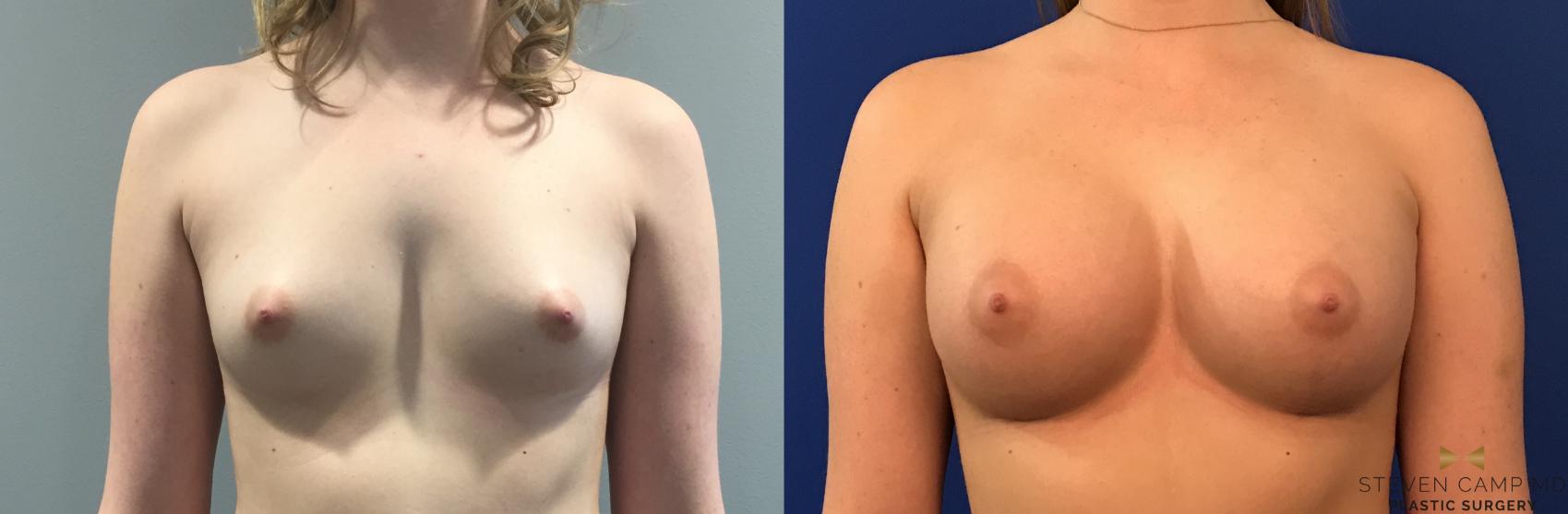 Before & After Breast Augmentation Case 99 View #1 View in Fort Worth, Texas