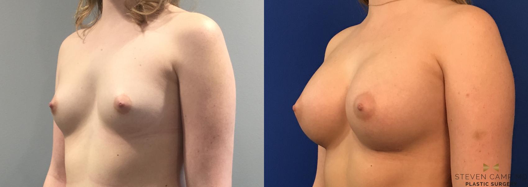 Before & After Breast Augmentation Case 99 View #2 View in Fort Worth, Texas