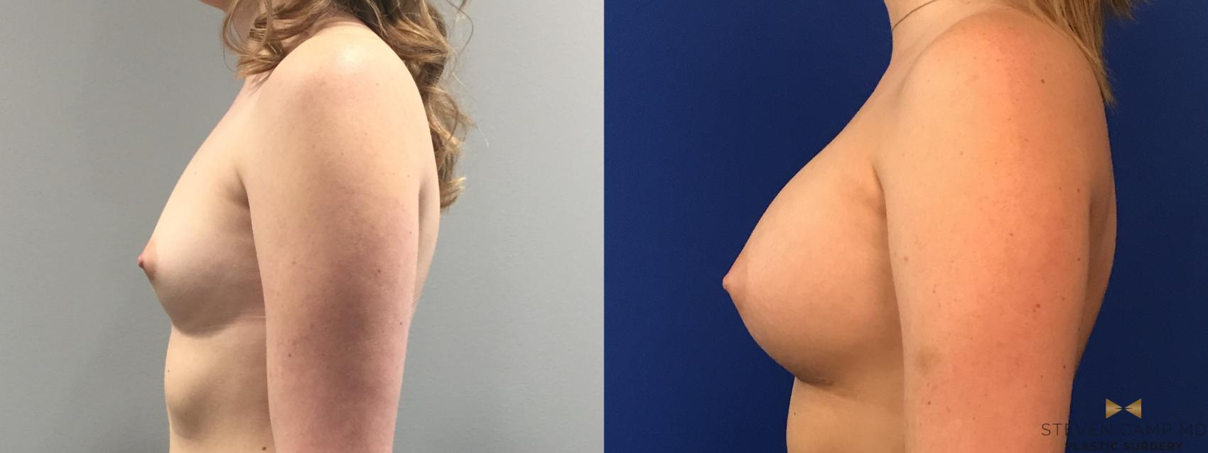 Before & After Breast Augmentation Case 99 View #3 View in Fort Worth, Texas