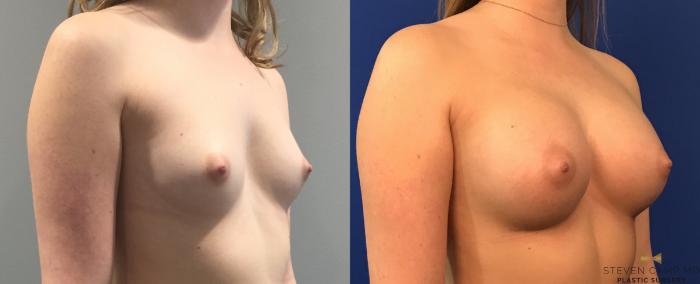 Before & After Breast Augmentation Case 99 View #4 View in Fort Worth, Texas