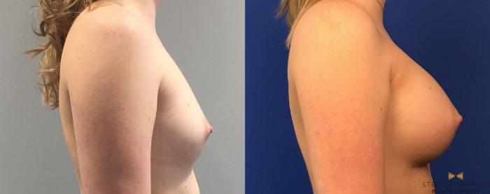 Before & After Breast Augmentation Case 99 View #5 View in Fort Worth, Texas