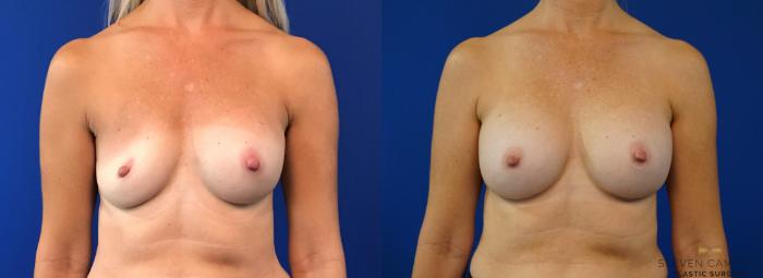 Before & After Breast Implant Exchange - NO LIFT  Case 125 View #1 View in Fort Worth & Arlington, Texas