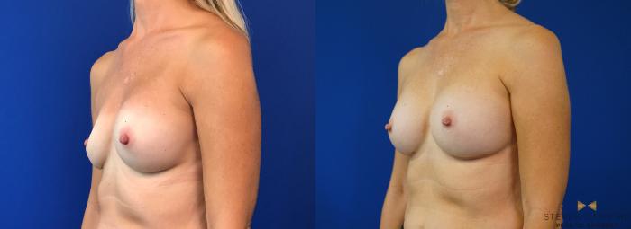 Before & After Breast Implant Exchange - NO LIFT  Case 125 View #2 View in Fort Worth & Arlington, Texas