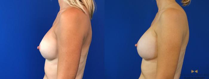 Before & After Breast Implant Exchange - NO LIFT  Case 125 View #3 View in Fort Worth, Texas