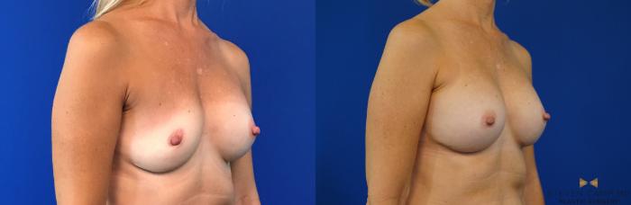 Before & After Breast Implant Exchange - NO LIFT  Case 125 View #4 View in Fort Worth, Texas