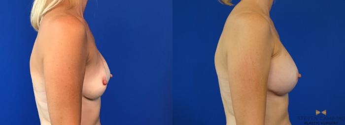 Before & After Breast Implant Exchange - NO LIFT  Case 125 View #5 View in Fort Worth & Arlington, Texas