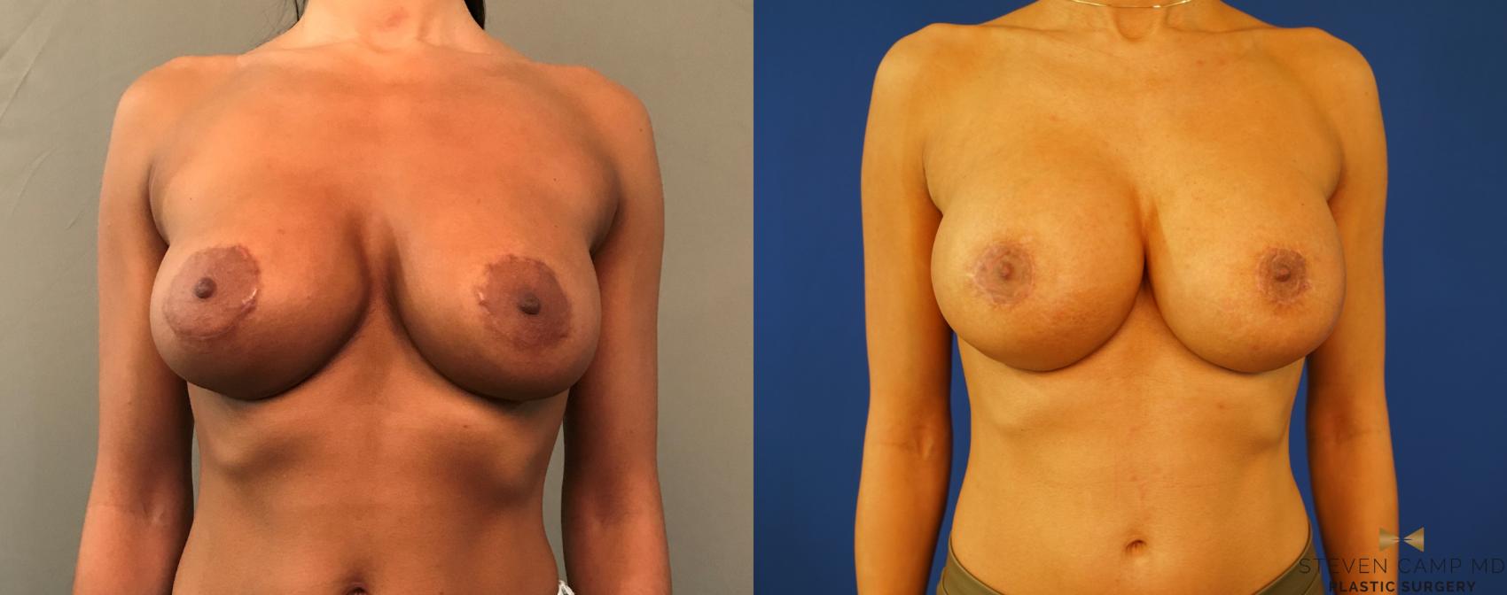 Breast Implant Exchange  Before & After Photo | Fort Worth, Texas | Steven Camp MD Plastic Surgery