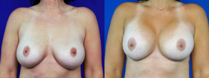 Before & After Breast Implant Exchange - NO LIFT  Case 201 View #1 View in Fort Worth & Arlington, Texas