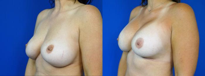 Before & After Breast Implant Exchange - NO LIFT  Case 201 View #2 View in Fort Worth & Arlington, Texas