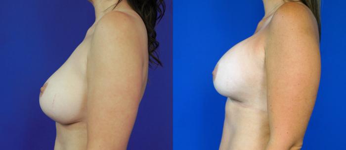 Before & After Breast Implant Exchange - NO LIFT  Case 201 View #4 View in Fort Worth & Arlington, Texas